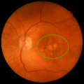 Advances in Imaging Macular Atrophy for Late-Stage Age-Related Macular Degeneration